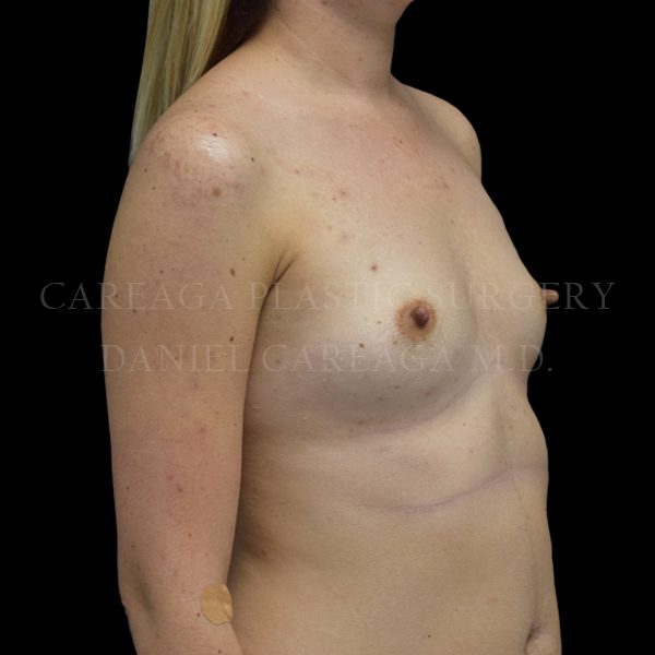 Breast Augmentation case 020 before, view 2