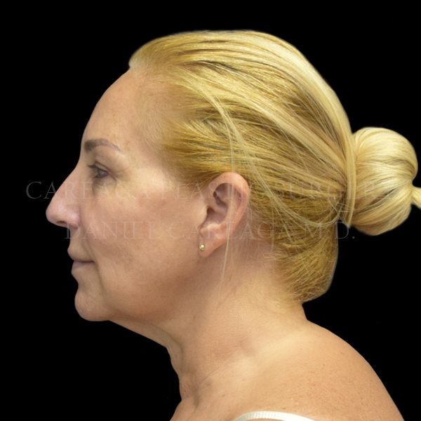 Facelift case 006 before, view 2
