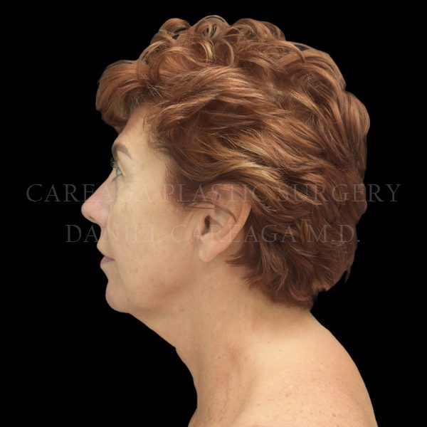 Facelift case 007 before, view 2