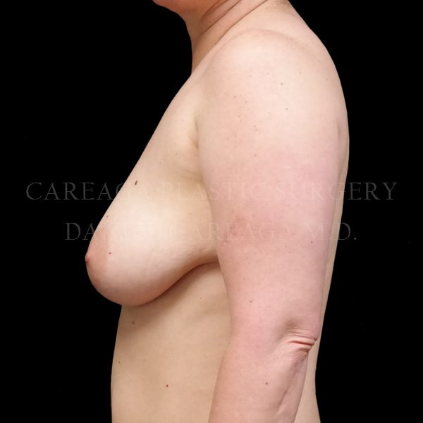 Breast Lift case 006 before, view 2