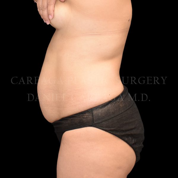 Tummy Tuck case 026 before, view 2