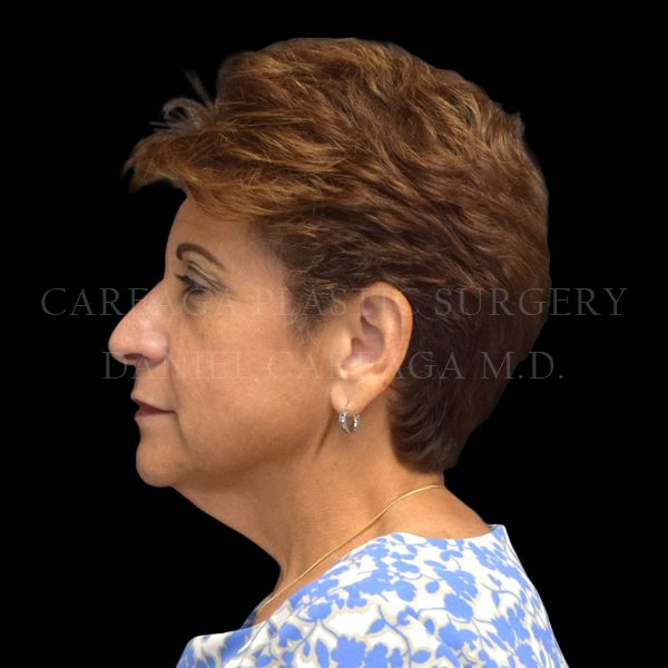 Facelift case 008 before, view 2