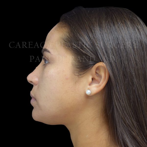 Rhinoplasty case 013 before, view 2