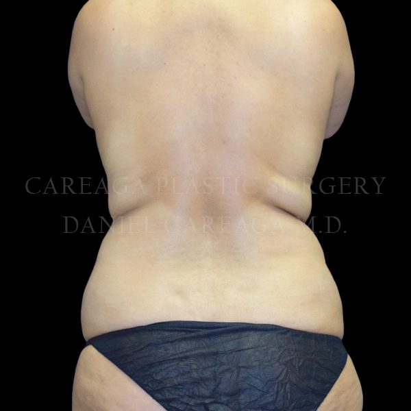 Liposuction case 011 before, view 2