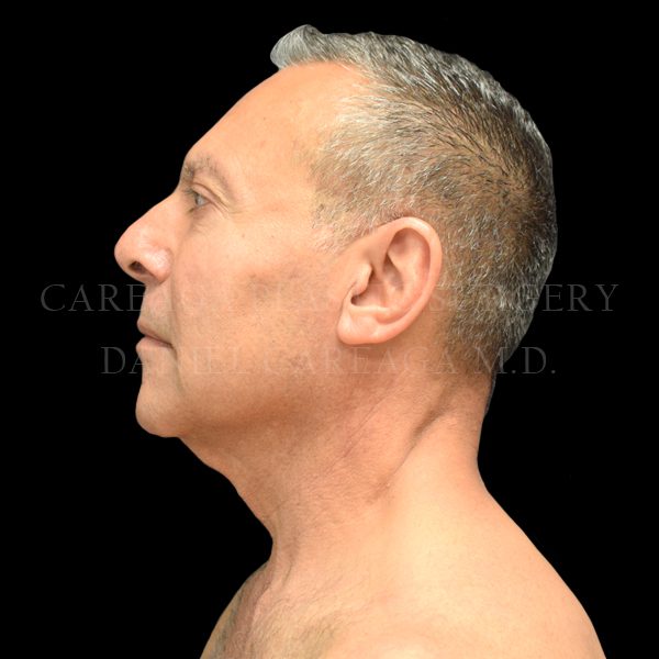 Facelift case 009 before