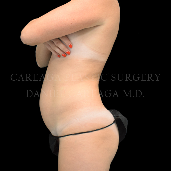 Tummy Tuck case 027 before, view 2