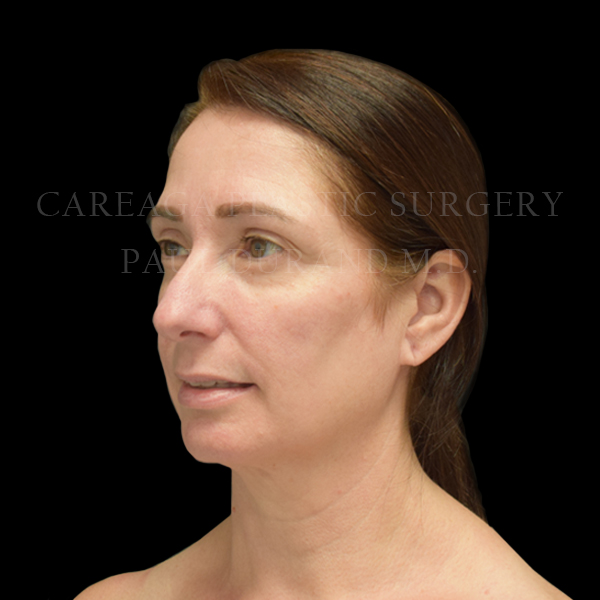 Rhinoplasty case 015 before, view 2