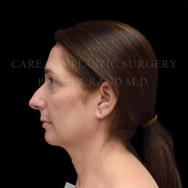 Rhinoplasty case 015 before