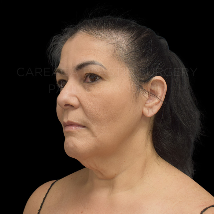 Facelift Case #32005 before, view 2