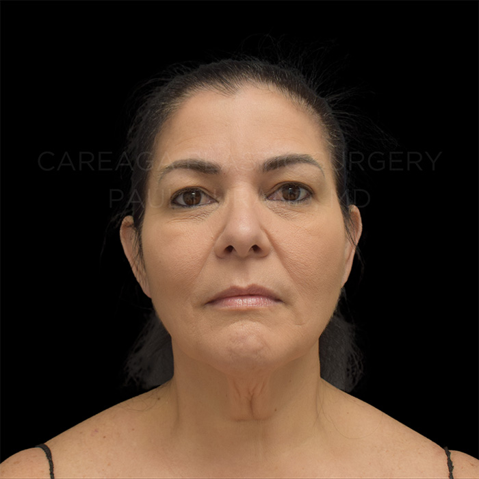 Facelift-Case--32005 | Before Facelift