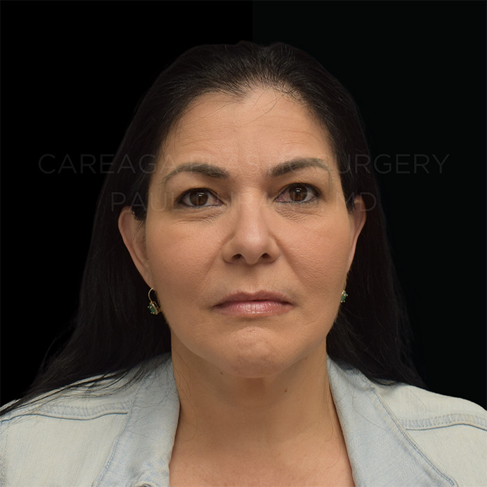 Facelift-Case--32005 | After Facelift