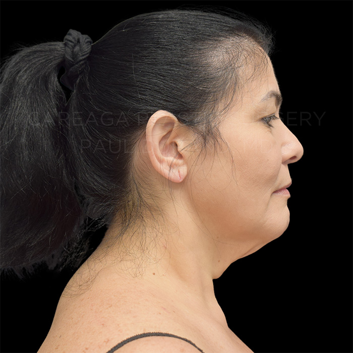 Facelift Case #32005 before, view 5