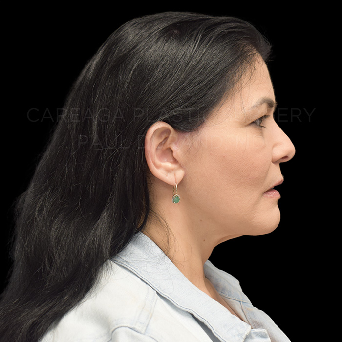 Facelift Case #32005 after, view 5