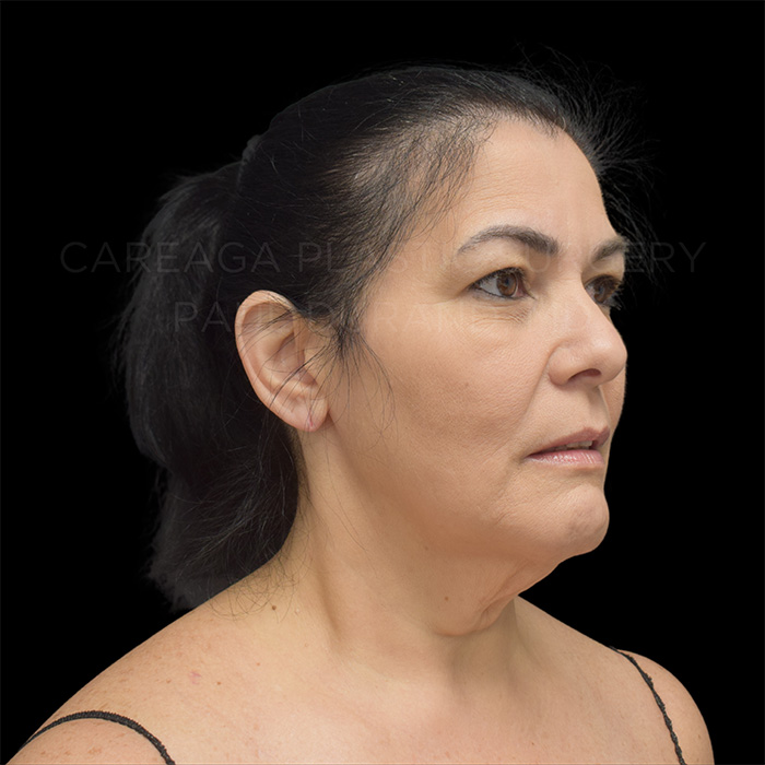 Facelift Case #32005 before, view 4