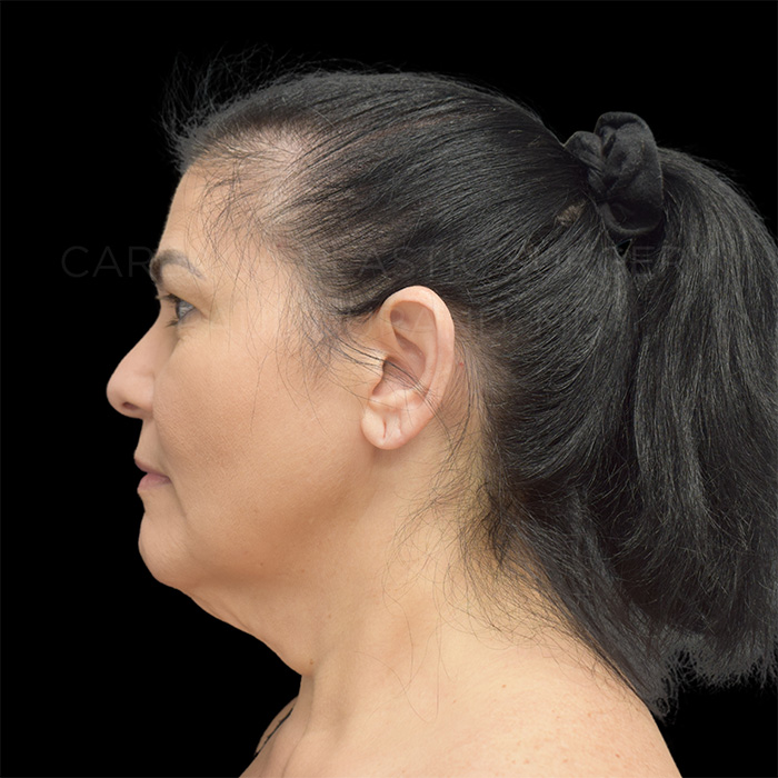 Facelift Case #32005 before, view 3