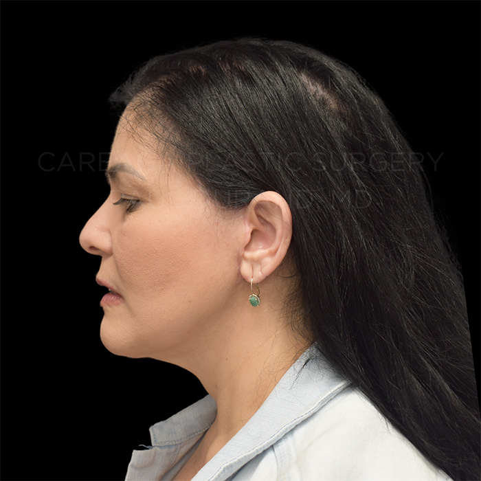 Facelift Case #32005 after, view 3