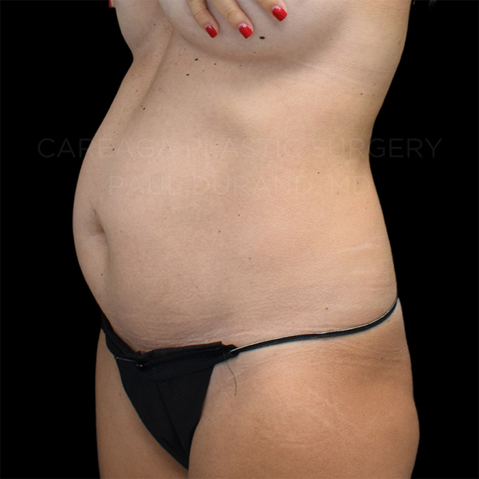 Tummy Tuck Case #26621 before, view 2