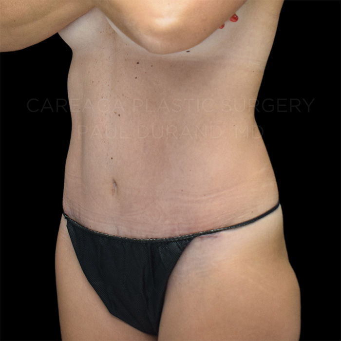 Tummy Tuck Case #26621 after, view 2