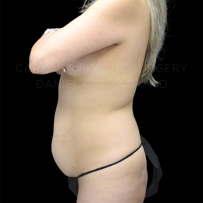 Tummy Tuck Case #30141 before, view 3
