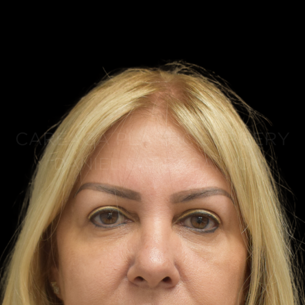 Blepharoplasty Case #29772 after, view 2