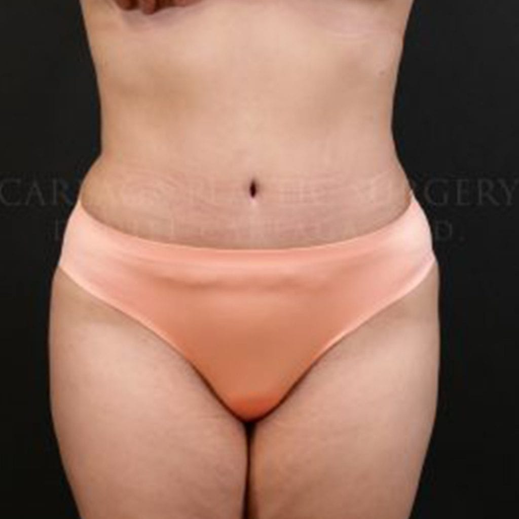 Tummy Tuck Case 6349 after