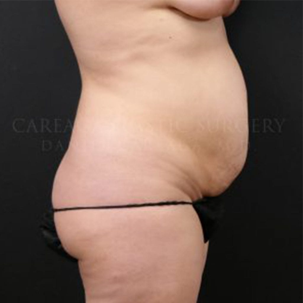 Tummy Tuck Case 6349 before, view 2