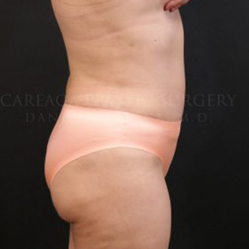 Tummy Tuck Case 6349 after, view 2