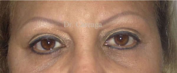 Blepharoplasty-Case-3200 | After Blepharoplasty