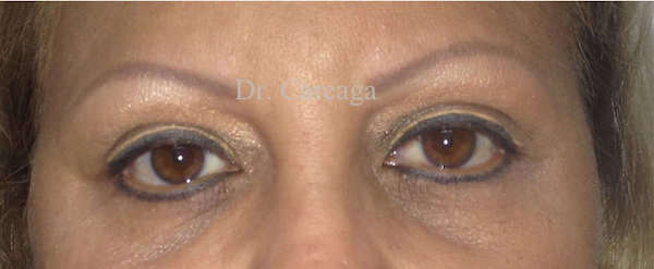 Blepharoplasty Case 3200 after