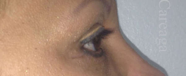 Blepharoplasty Case 3200 after, view 2