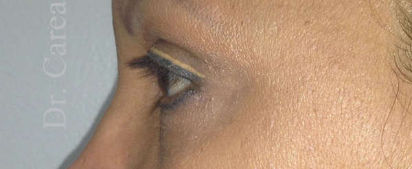 Blepharoplasty Case 3200 after, view 3