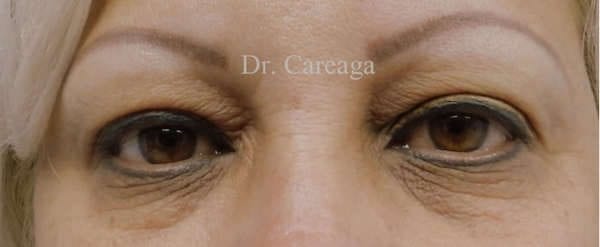 Blepharoplasty-Case-3200 | Before Blepharoplasty