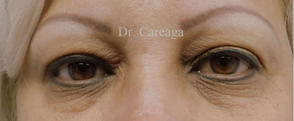 Blepharoplasty Case 3200 before