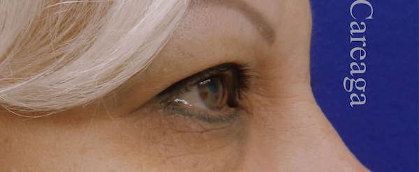Blepharoplasty Case 3200 before, view 2