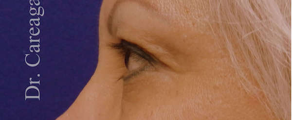 Blepharoplasty Case 3200 before, view 3