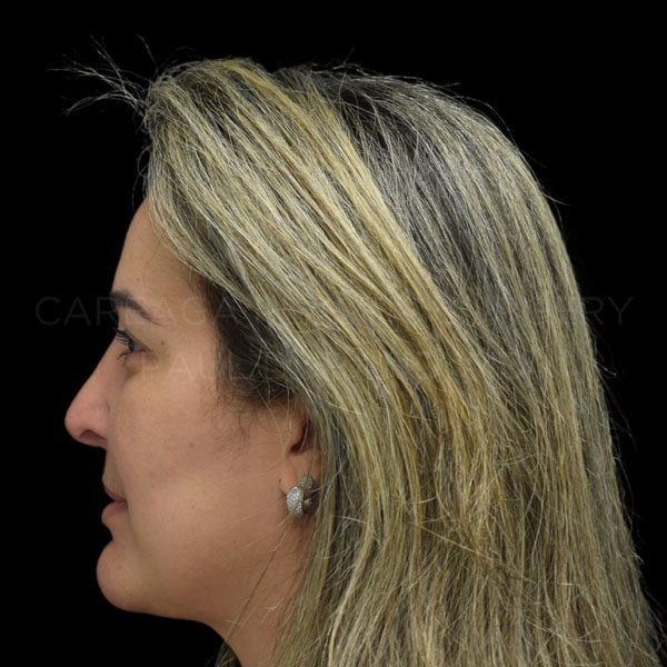 Rhinoplasty Revision Case #20605 after, view 2