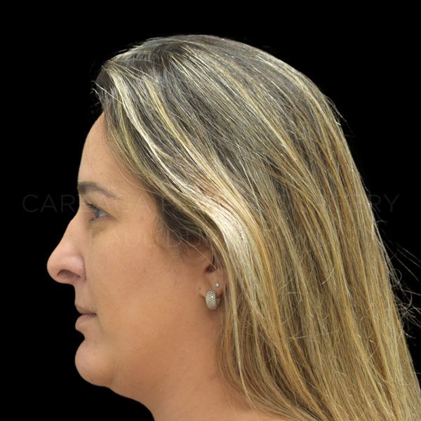 Rhinoplasty Revision Case #20605 before, view 2