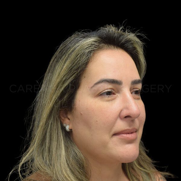 Rhinoplasty-Revision-Case--20605 | After Rhinoplasty Revision