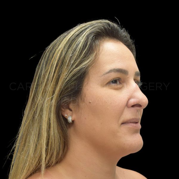 Rhinoplasty-Revision-Case--20605 | Before Rhinoplasty Revision