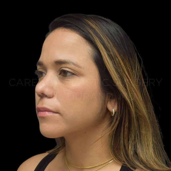 Rhinoplasty-Revision-Case--30503 | After Rhinoplasty Revision