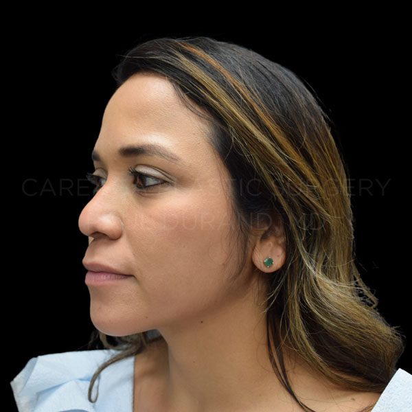 Rhinoplasty-Revision-Case--30503 | Before Rhinoplasty Revision
