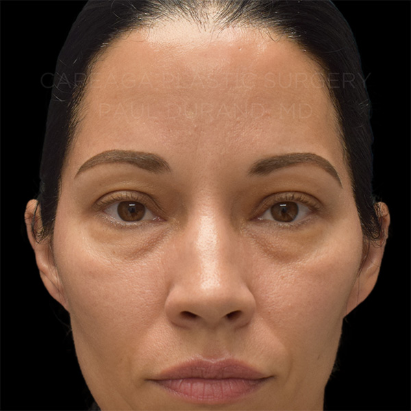 Blepharoplasty-Case--32590 | Before Blepharoplasty