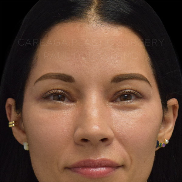 Blepharoplasty-Case--32590 | After Blepharoplasty